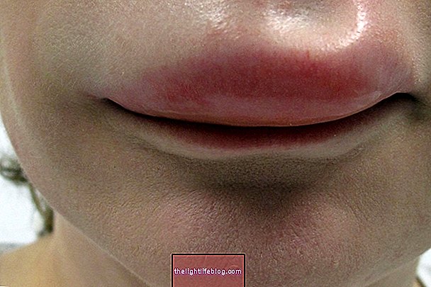 Main symptoms of angioedema, why it happens and treatment