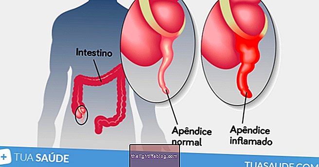 Appendicite: qu'est-ce que c'est, symptômes et traitement