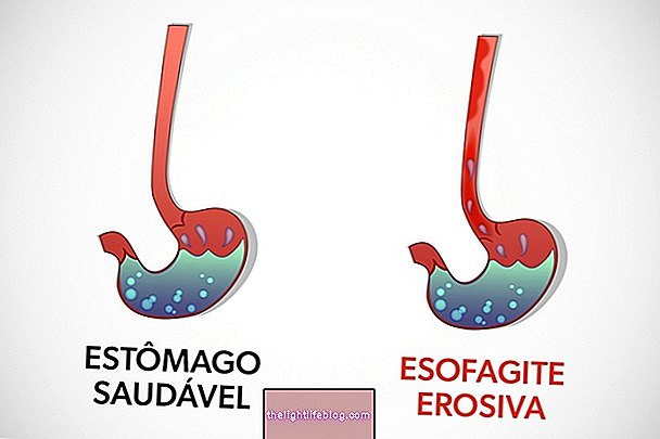 Erosive esophagitis คืออะไรการรักษาและการจำแนกประเภทของลอสแองเจลิส