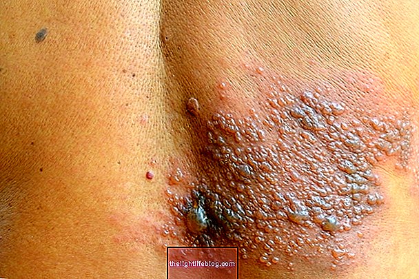 Apa itu dan bagaimana merawat dermatitis herpetiform
