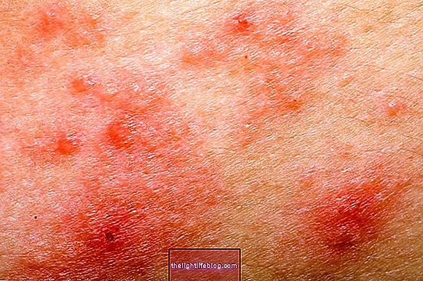 Purpura: what it is, types, symptoms and treatment