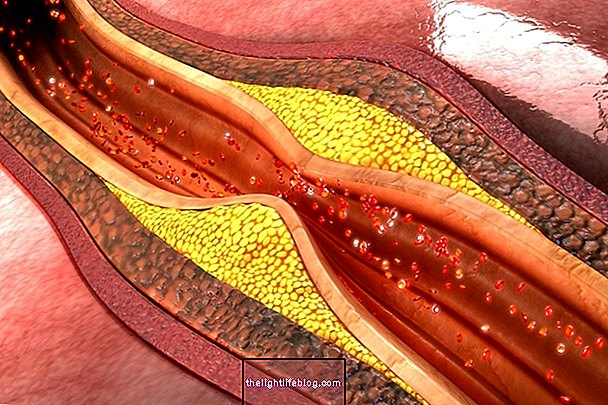 Aterosklerosis: apa itu, gejala, sebab dan rawatan