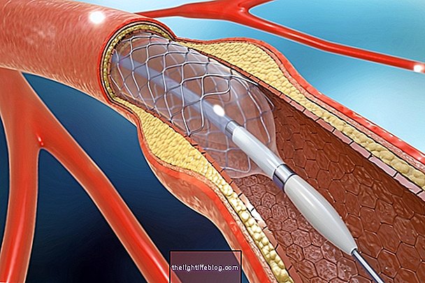 Stent: what it is, what it is for and main types