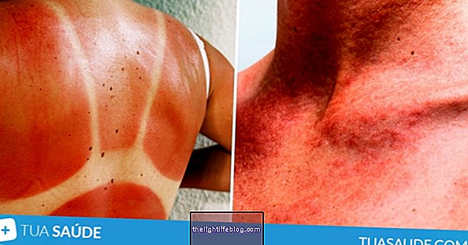 How to identify and treat the 6 most common skin diseases in summer