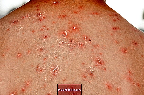 Wild fire disease: what it is, symptoms, causes and treatment