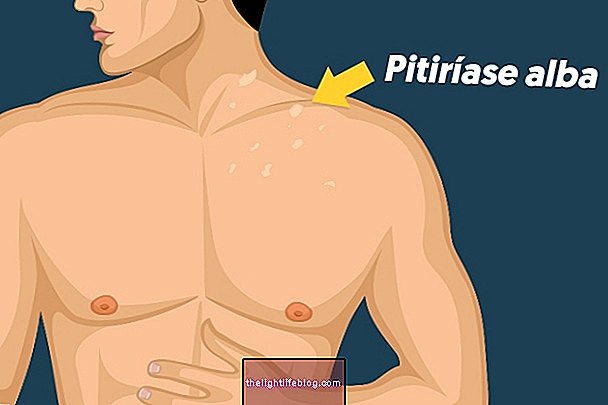 Hvad er Pityriasis alba og hvordan man behandler det