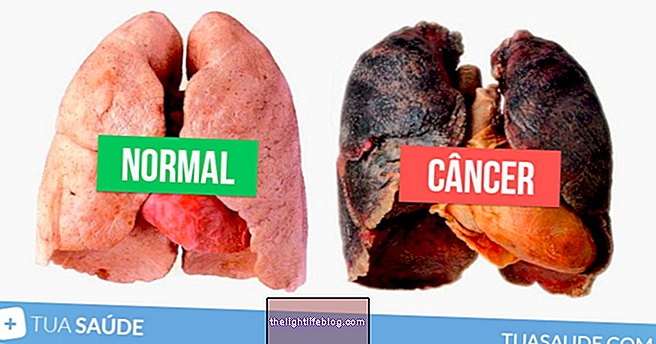 Rak pluća: mogućnosti liječenja i liječenja