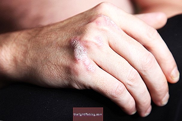 Systemic sclerosis: what it is, symptoms and treatment