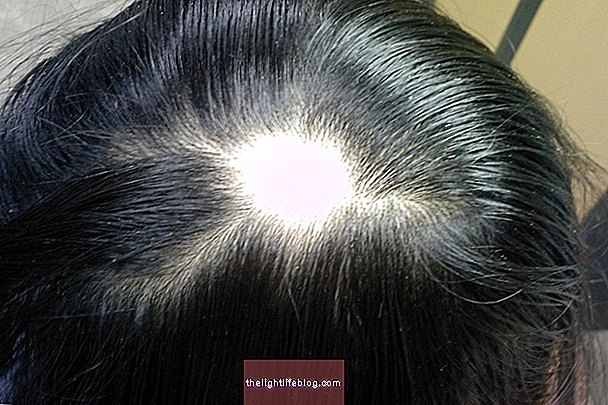 Alopecia areata: มันคืออะไรสาเหตุที่เป็นไปได้และวิธีการระบุ