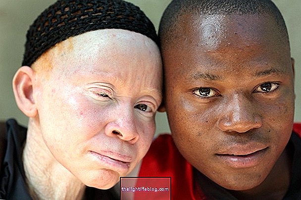 Înțelegeți mai bine ce este albinismul