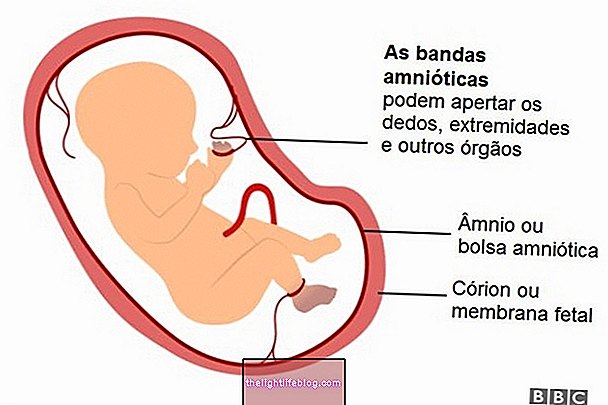 What is amniotic band syndrome, causes and how to treat
