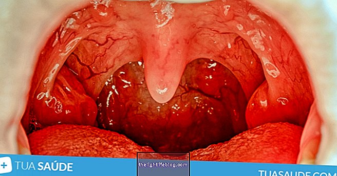 Tonsillitis: how to know if it is viral or bacterial?