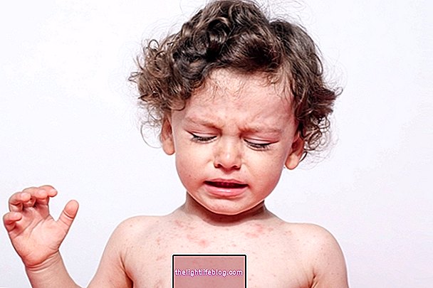 Measles Duration, possible complications and how to prevent