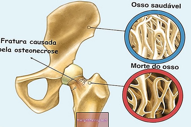 Mi az osteonecrosis és hogyan lehet azonosítani