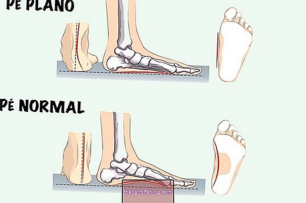Čo je valgusová noha a čo treba urobiť na nápravu