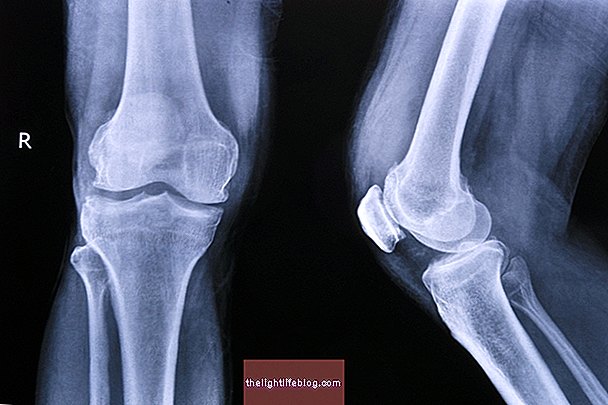 Liečba artrózy kolena