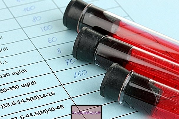Hemoglobinuria nokturnal paroxysmal: apakah itu dan bagaimana diagnosis dibuat