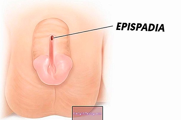 What is Epispadia and How to Treat It