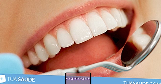 दांतों को सफेद करने के 4 उपचार के विकल्प