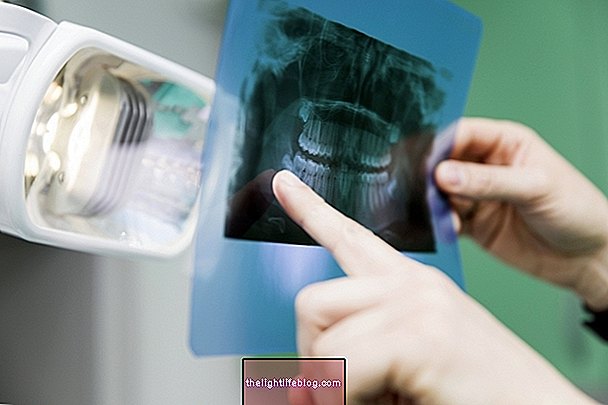 Dentigerous cyst - apakah itu dan bagaimana ia dilakukan