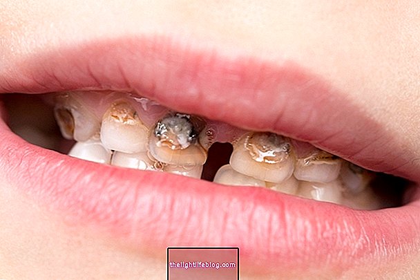 How to treat tooth enamel hypoplasia