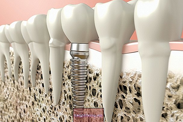 Dental implant: what it is, when it is indicated and how it is done