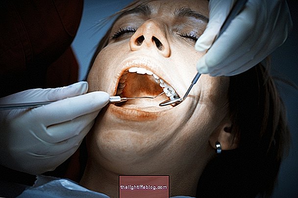 Was ist Zahnfüllung, wann wird sie angezeigt und wie wird sie durchgeführt?