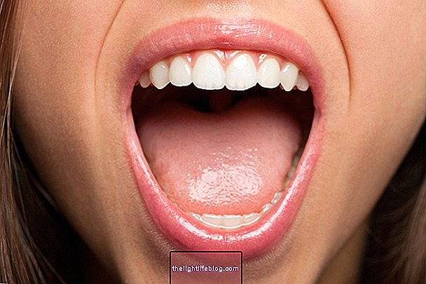Hvad er oral candidiasis, symptomer og hvordan man behandler