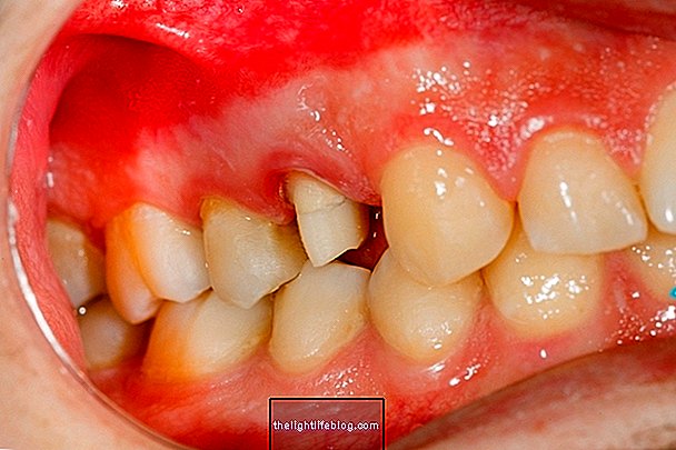Hvad er og hvordan man behandler nekrotiserende ulcerøs tandkødsbetændelse