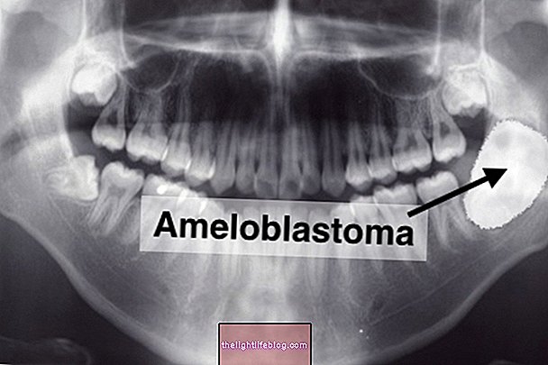 Hvad er ameloblastom og hvordan man behandler det