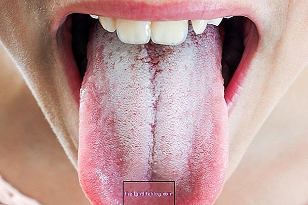 Qu'est-ce que le saburra lingual, principales causes et traitement