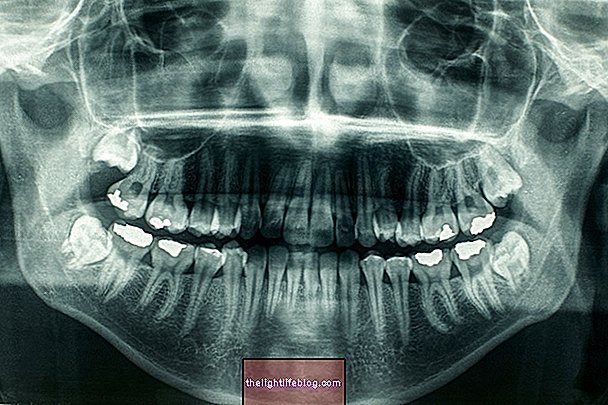 X-ray oral panoramik (Orthopantomography): untuk apa dan bagaimana ia dilakukan?