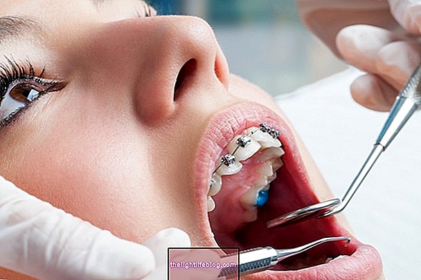 Typer af dental malocclusion og hvordan man behandler