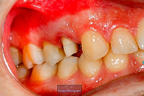 Behandlung von geschwollenem Zahnfleisch