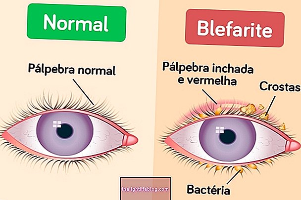 Was ist Blepharitis (geschwollenes Augenlid) und wie zu behandeln
