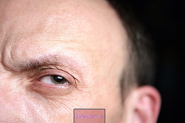 What is blepharospasm, what causes it, symptoms and treatment