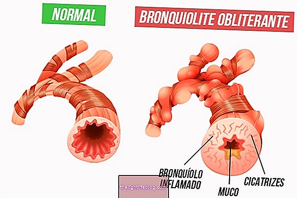 מה זה bronchiolitis obliterans, תסמינים, סיבות וכיצד לטפל
