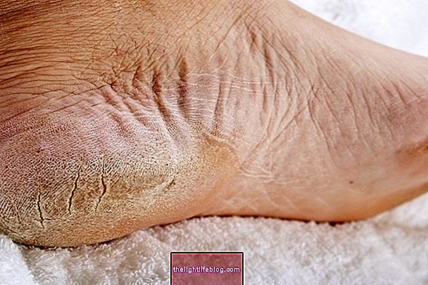 Peeling foot: 5 main causes and what to do