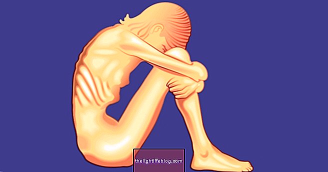 Anzeichen und Symptome von Anorexia nervosa und wie ist die Behandlung
