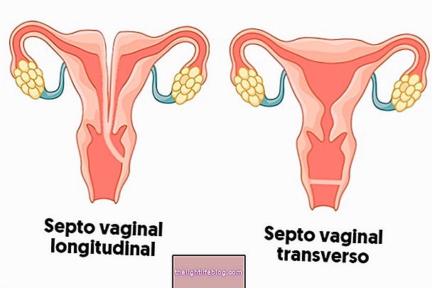 Was ist das Vaginalseptum und wie zu behandeln