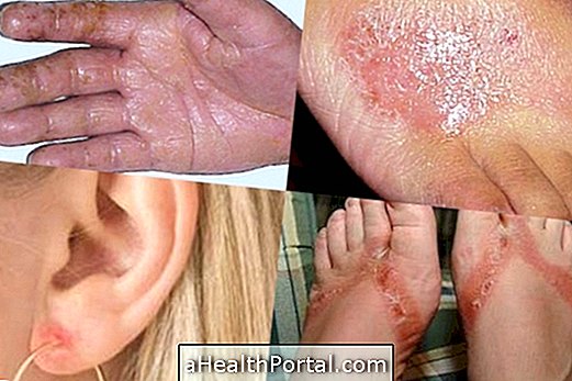 Co je kontaktní dermatitida a jak zacházet