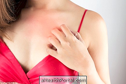 What is cholinergic urticaria and how to treat it