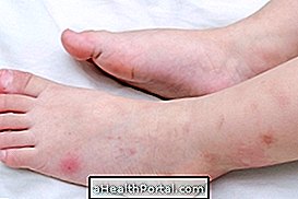 昆虫の咬傷に対するアレルギーの場合の処置