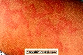 How to Identify and Treat Urticaria