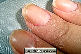 les allergies - Dermatite de contact irritant