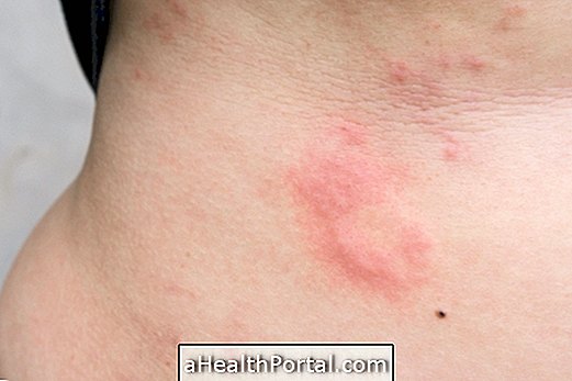 How is the treatment for urticaria done?