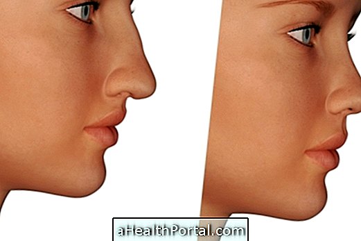 Een operatie aan de neus kan het zelfrespect en de ademhaling verbeteren
