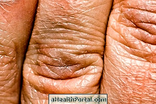 Hovedkarakteristika for tør hud