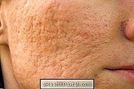 Mandelsyre behandling for acne ar