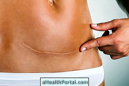 Plastic surgery to take scar: when and how to do